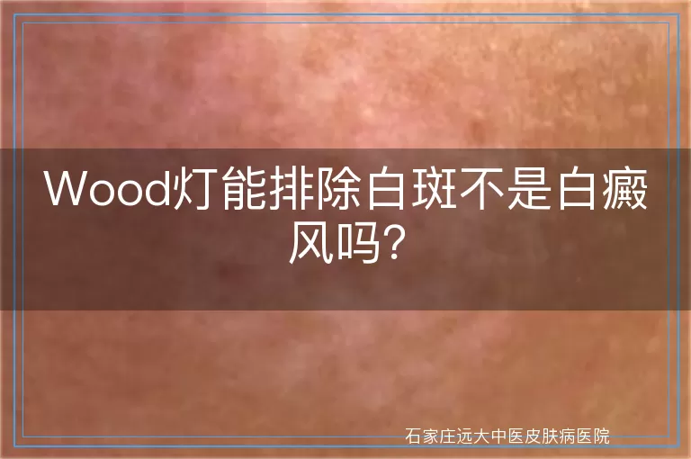 Wood灯能排除白斑不是白癜风吗？