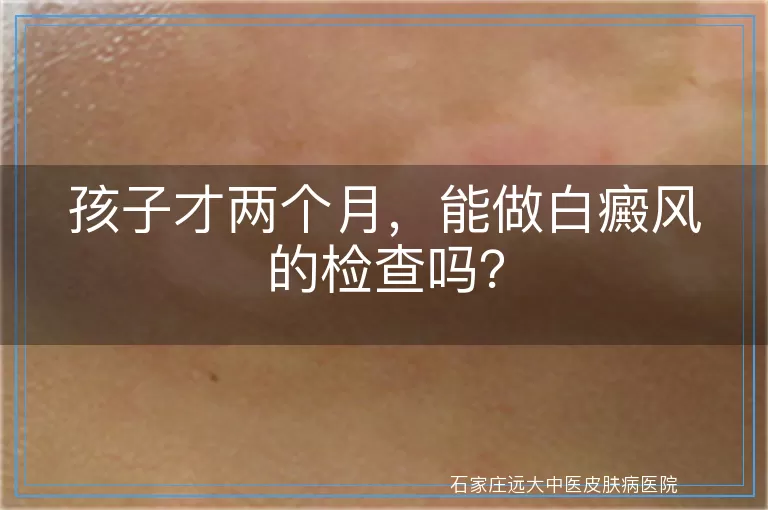 孩子才两个月，能做白癜风的检查吗？