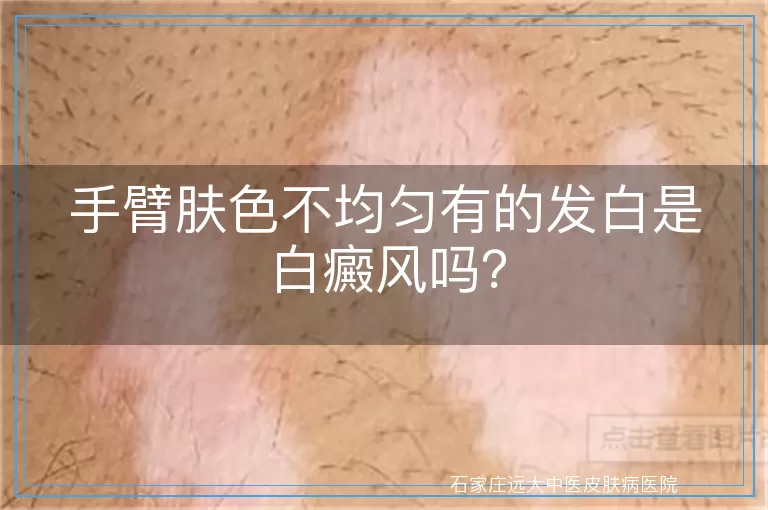 手臂肤色不均匀有的发白是白癜风吗？