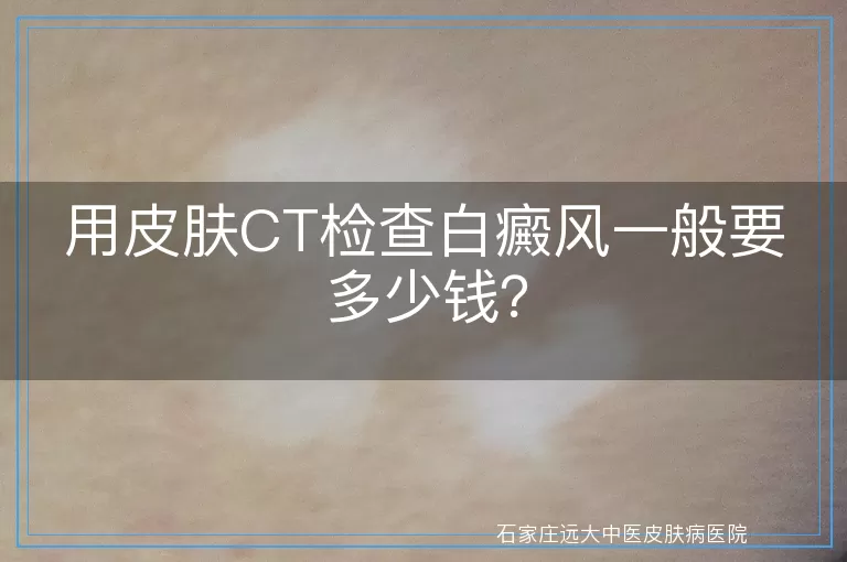 用皮肤CT检查白癜风一般要多少钱？