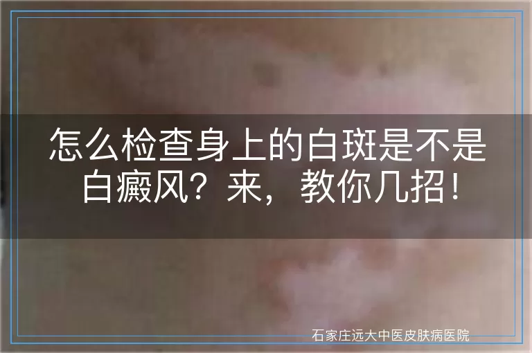 怎么检查身上的白斑是不是白癜风？来，教你几招！