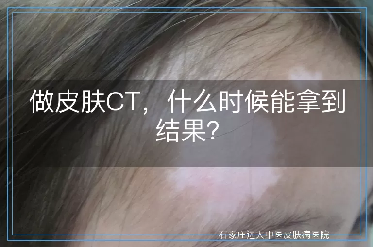 做皮肤CT，什么时候能拿到结果？