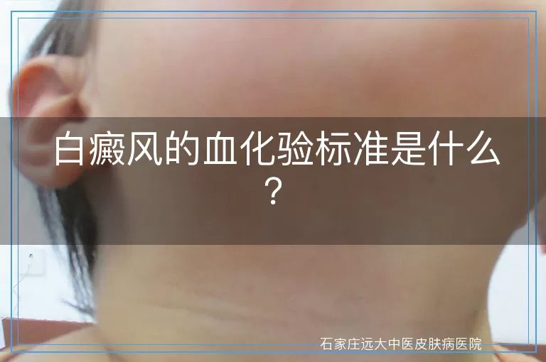 白癜风的血化验标准是什么？