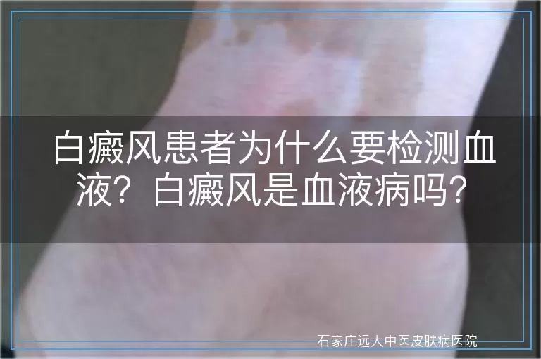 白癜风患者为什么要检测血液？白癜风是血液病吗？