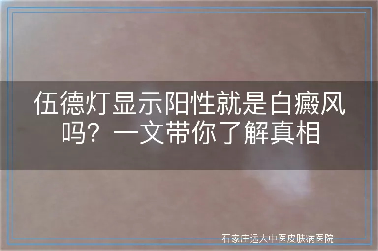 伍德灯显示阳性就是白癜风吗？一文带你了解真相