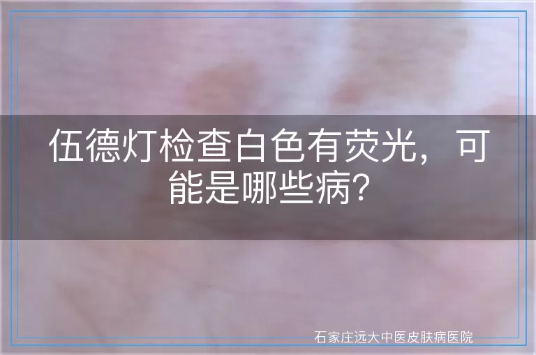 伍德灯检查白色有荧光，可能是哪些病？