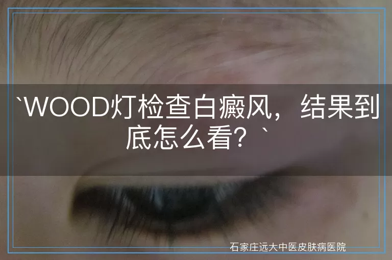 WOOD灯检查白癜风，结果到底怎么看？