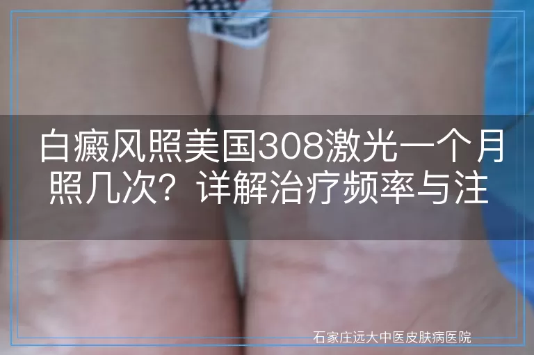 白癜风照美国308激光一个月照几次？详解治疗频率与注意事项