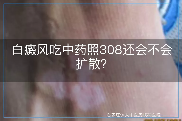 白癜风吃中药照308还会不会扩散？