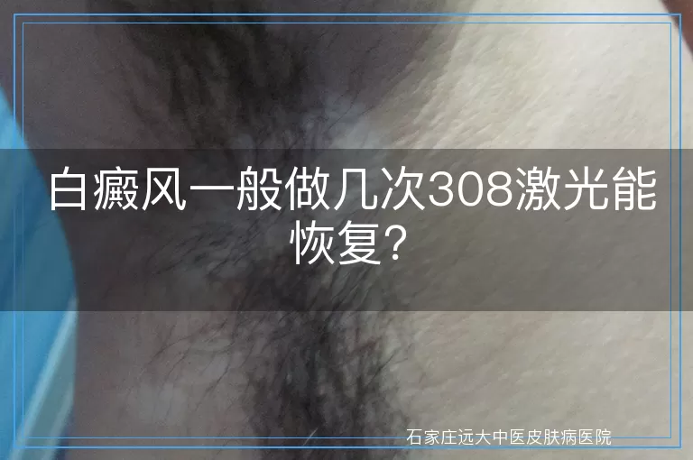 白癜风一般做几次308激光能恢复？