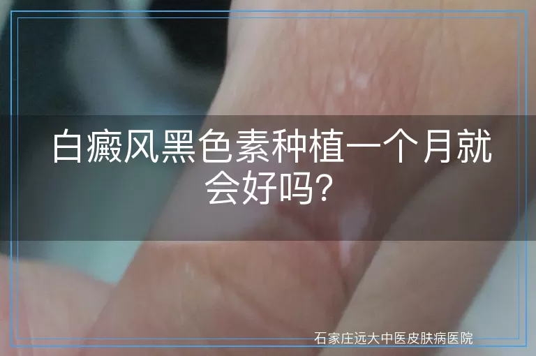 白癜风黑色素种植一个月就会好吗？