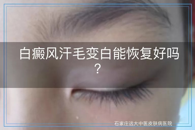 白癜风汗毛变白能恢复好吗？