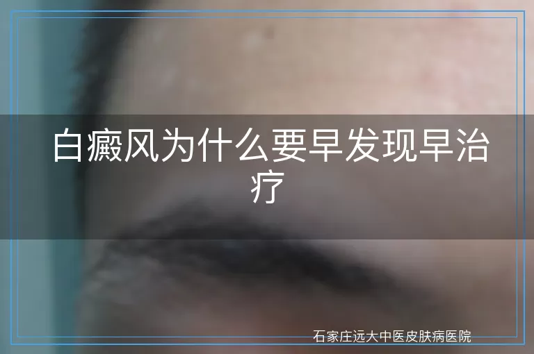 白癜风为什么要早发现早治疗