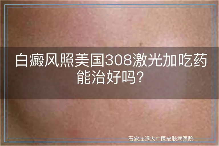 白癜风照美国308激光加吃药能治好吗？