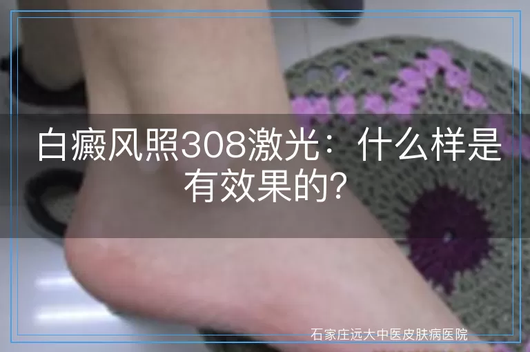 白癜风照308激光：什么样是有效果的？