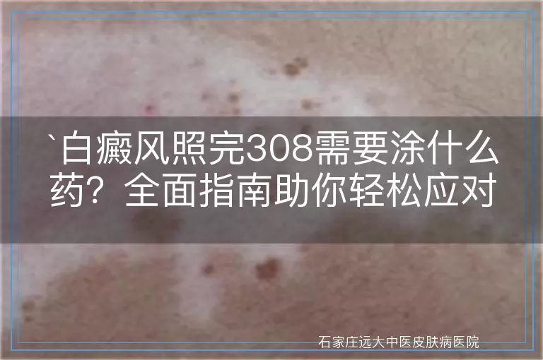 `白癜风照完308需要涂什么药？全面指南助你轻松应对`