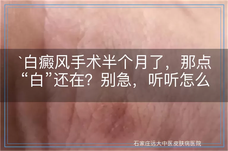 `白癜风手术半个月了，那点“白”还在？别急，听听怎么说`