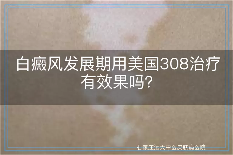 白癜风发展期用美国308治疗有效果吗？