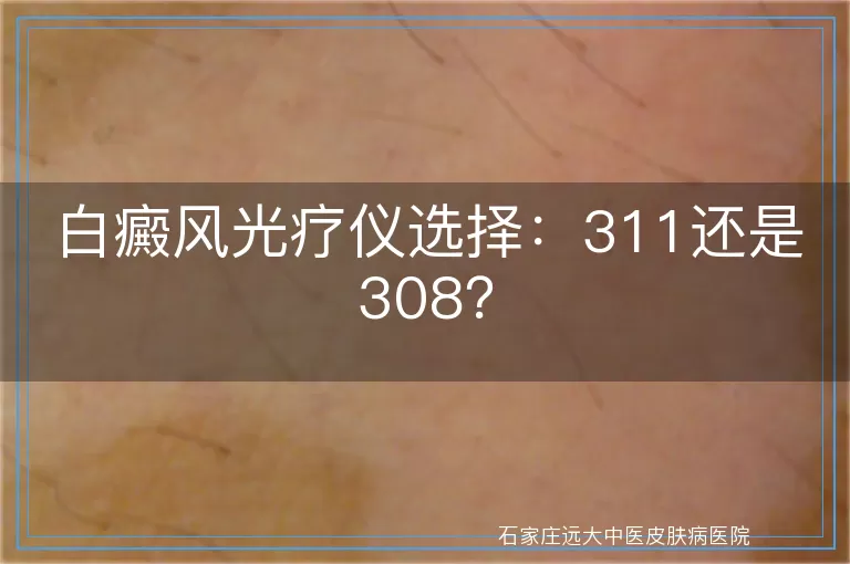 白癜风光疗仪选择：311还是308？