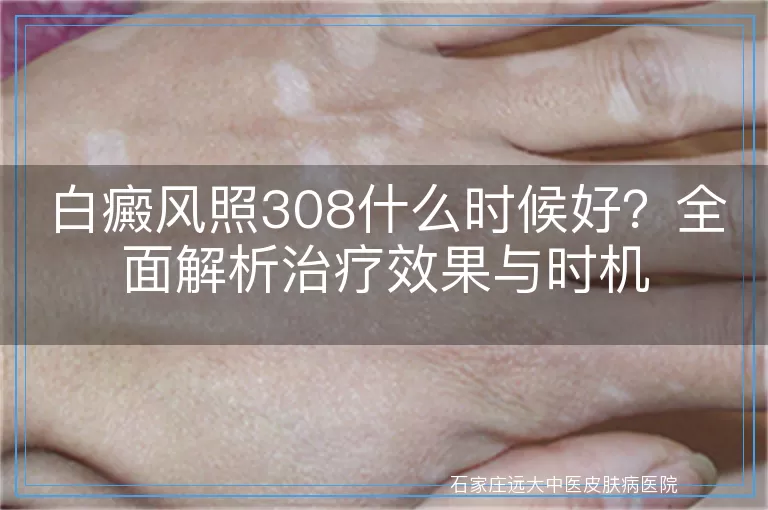 白癜风照308什么时候好？全面解析治疗效果与时机