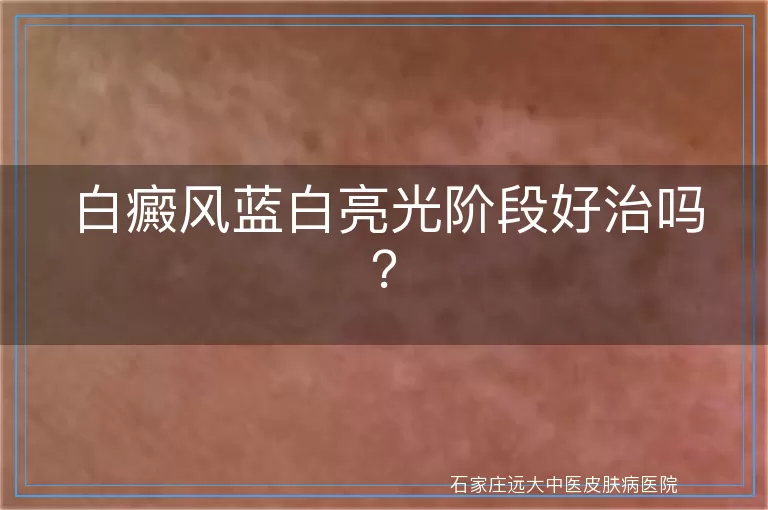 白癜风蓝白亮光阶段好治吗？