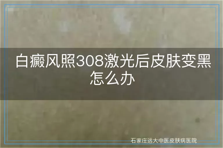 白癜风照308激光后皮肤变黑怎么办