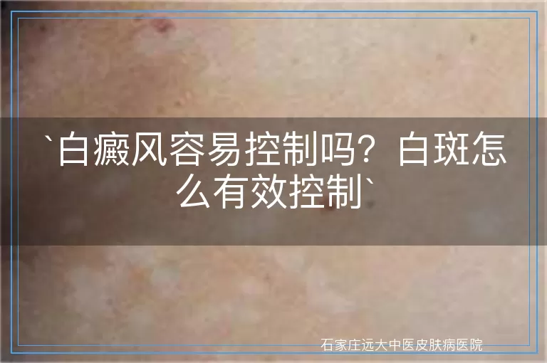 `白癜风容易控制吗？白斑怎么有效控制`