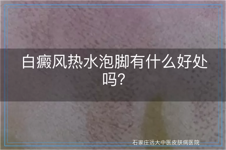 白癜风热水泡脚有什么好处吗？