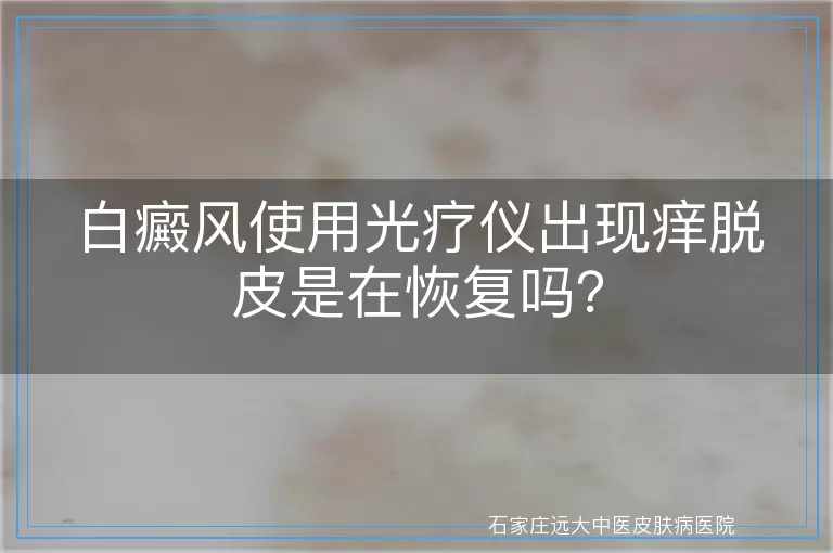 白癜风使用光疗仪出现痒脱皮是在恢复吗？