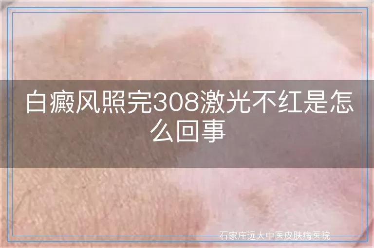 白癜风照完308激光不红是怎么回事