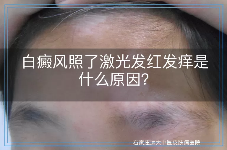 白癜风照了激光发红发痒是什么原因？