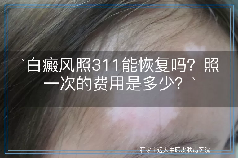 `白癜风照311能恢复吗？照一次的费用是多少？`