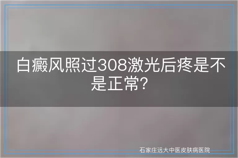 白癜风照过308激光后疼是不是正常？