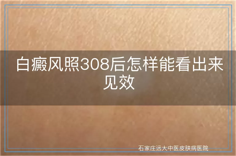 白癜风照308后怎样能看出来见效