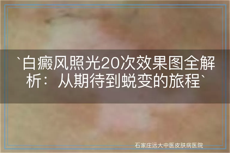 白癜风照光20次效果图全解析：从期待到蜕变的旅程