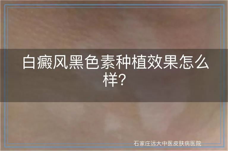 白癜风黑色素种植效果怎么样？