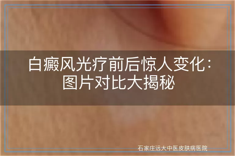 白癜风光疗前后惊人变化：图片对比大揭秘