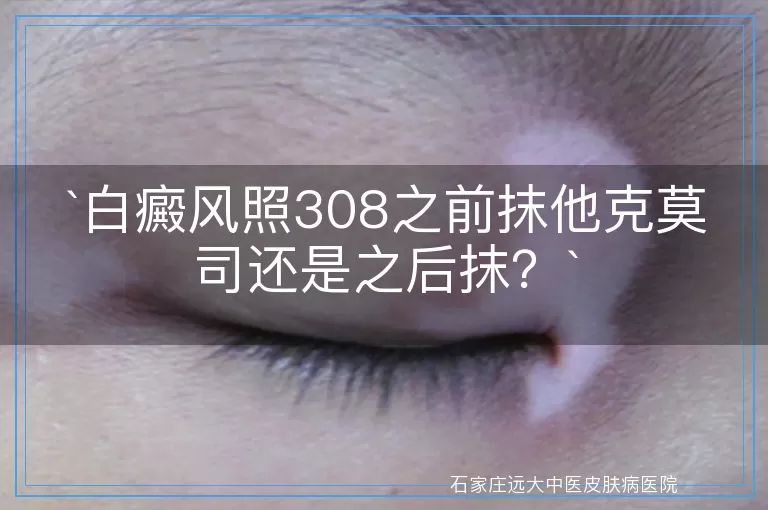 白癜风照308之前抹他克莫司还是之后抹？