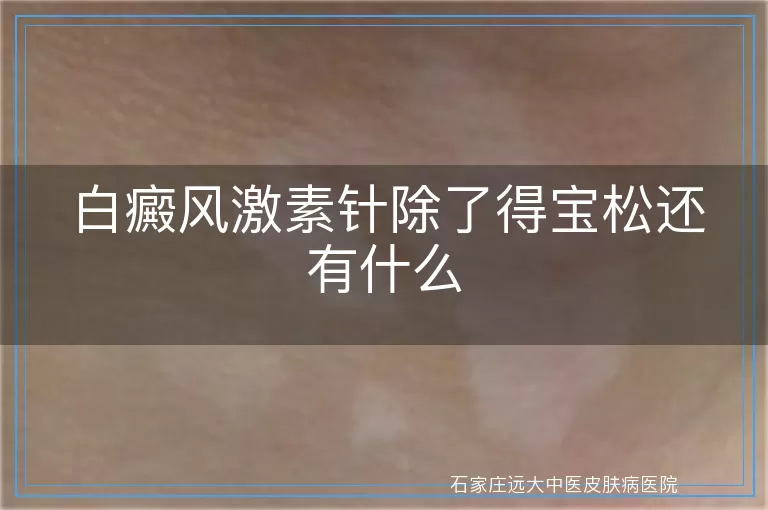 白癜风激素针除了得宝松还有什么