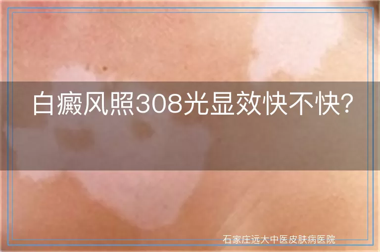 白癜风照308光显效快不快？