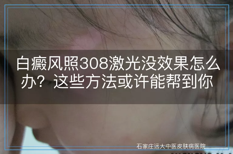 白癜风照308激光没效果怎么办？这些方法或许能帮到你