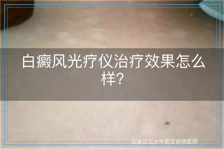 白癜风光疗仪治疗效果怎么样？