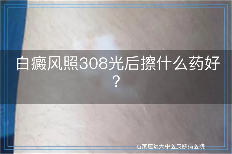 白癜风照308光后擦什么药好？