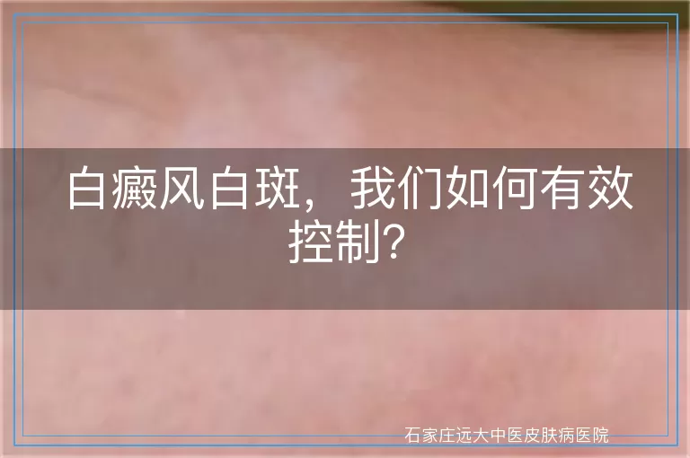 白癜风白斑，我们如何有效控制？