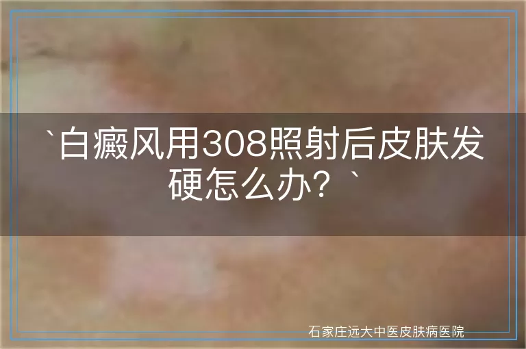 白癜风用308照射后皮肤发硬怎么办？