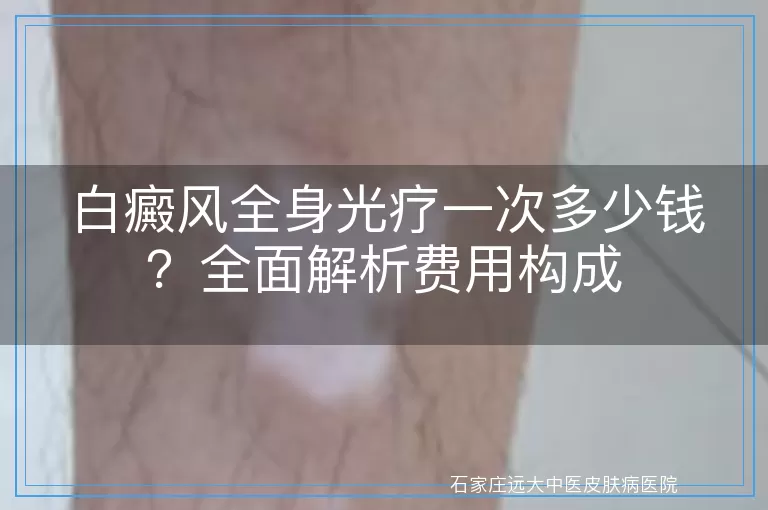 白癜风全身光疗一次多少钱？全面解析费用构成