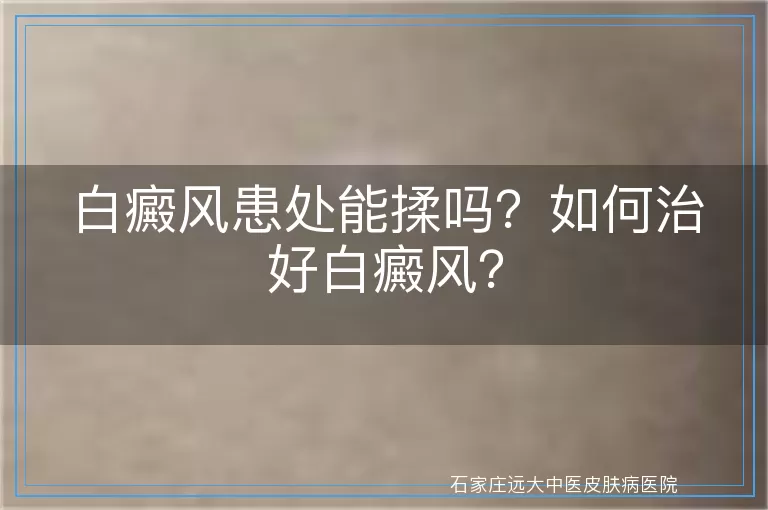 白癜风患处能揉吗？如何治好白癜风？