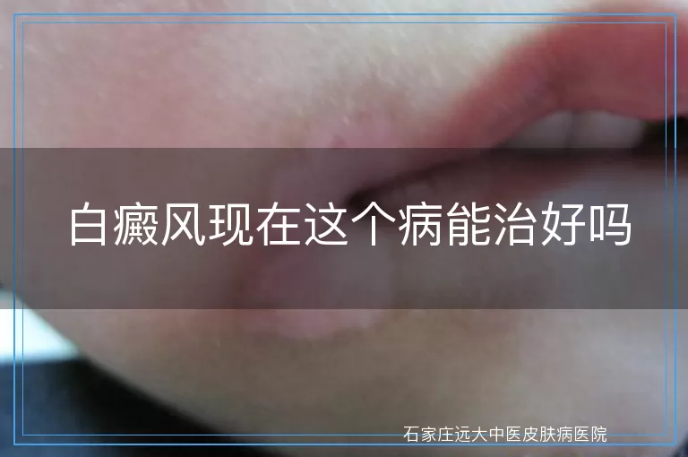 白癜风现在这个病能治好吗