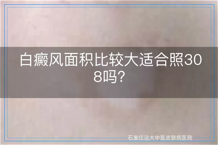 白癜风面积比较大适合照308吗？