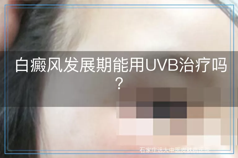 白癜风发展期能用UVB治疗吗？